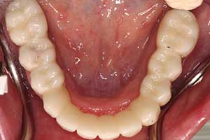 FullMouth Restoration