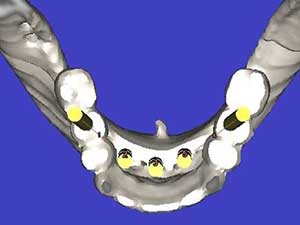 DentalImplants5