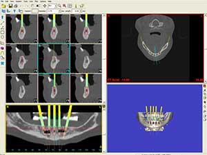 DentalImplants6